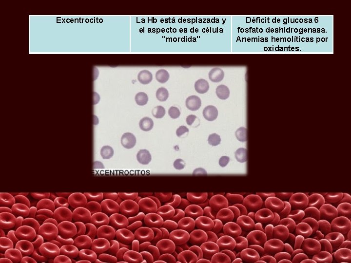 Excentrocito La Hb está desplazada y el aspecto es de célula "mordida" Déficit de