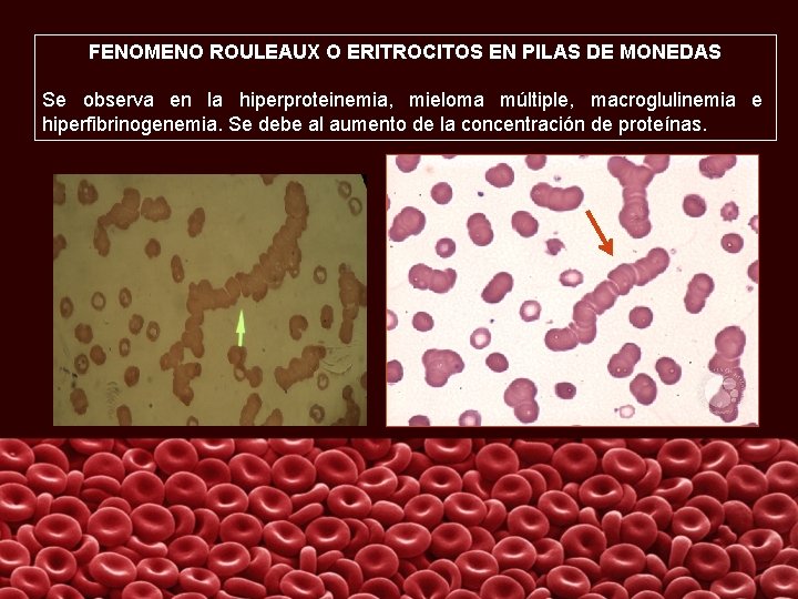 FENOMENO ROULEAUX O ERITROCITOS EN PILAS DE MONEDAS Se observa en la hiperproteinemia, mieloma