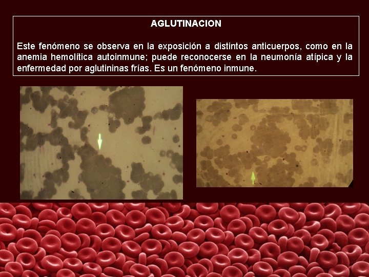 AGLUTINACION Este fenómeno se observa en la exposición a distintos anticuerpos, como en la