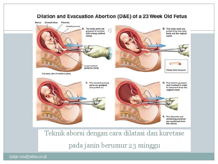 15 Teknik aborsi dengan cara dilatasi dan kuretase pada janin berumur 23 minggu tjahjo+nu@yahoo.
