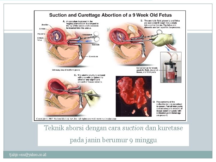16 Teknik aborsi dengan cara suction dan kuretase pada janin berumur 9 minggu tjahjo+nu@yahoo.