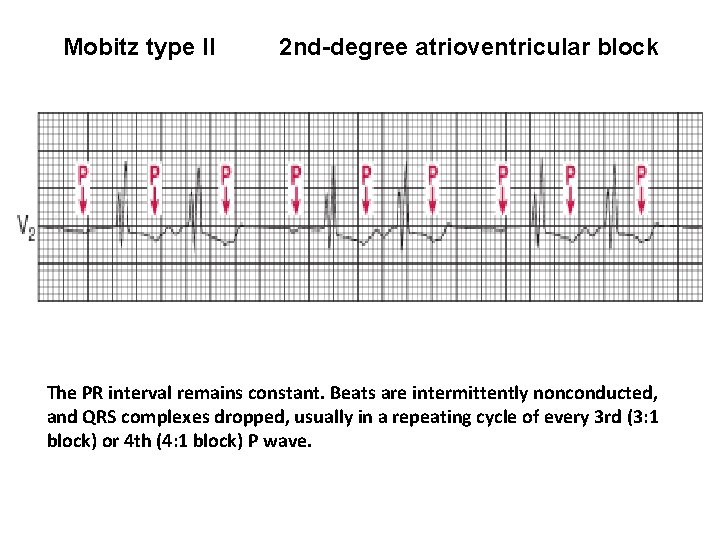 Mobitz type II 2 nd-degree atrioventricular block The PR interval remains constant. Beats are