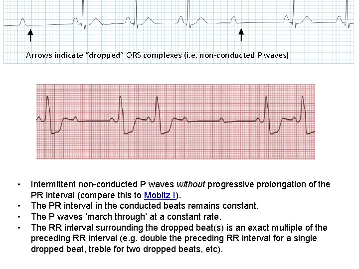 Arrows indicate “dropped” QRS complexes (i. e. non-conducted P waves) • • Intermittent non-conducted