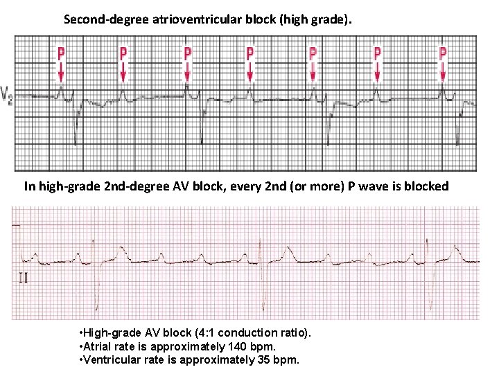 Second-degree atrioventricular block (high grade). In high-grade 2 nd-degree AV block, every 2 nd