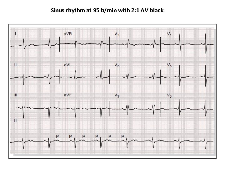 Sinus rhythm at 95 b/min with 2: 1 AV block 