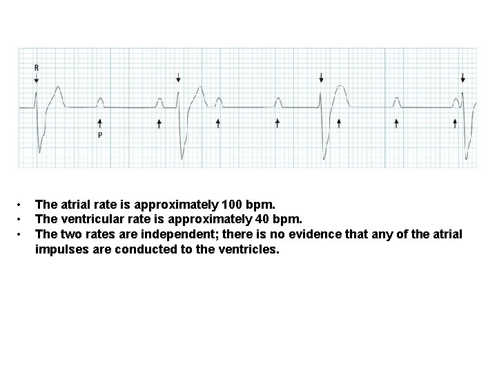  • • • The atrial rate is approximately 100 bpm. The ventricular rate