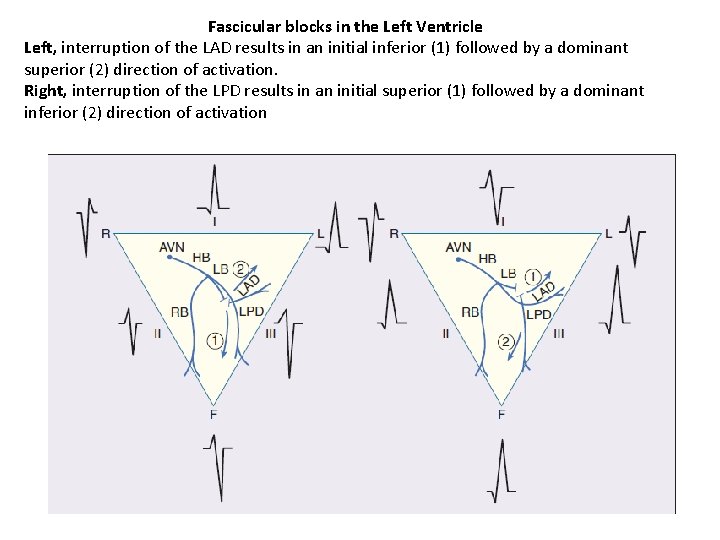 Fascicular blocks in the Left Ventricle Left, interruption of the LAD results in an