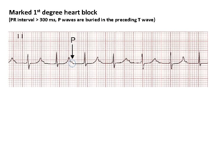 Marked 1 st degree heart block (PR interval > 300 ms, P waves are