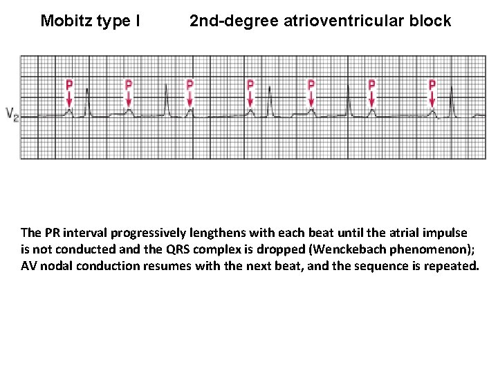 Mobitz type I 2 nd-degree atrioventricular block The PR interval progressively lengthens with each