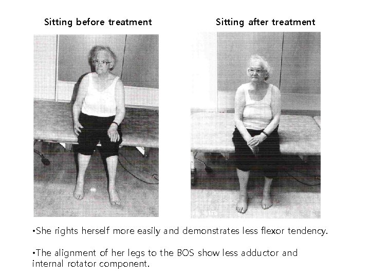 Sitting before treatment Sitting after treatment • She rights herself more easily and demonstrates