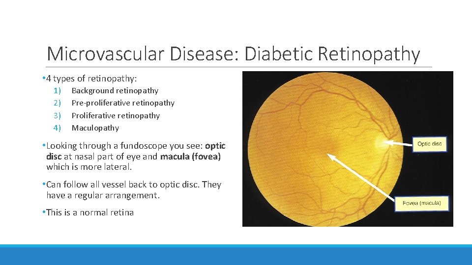 Microvascular Disease: Diabetic Retinopathy • 4 types of retinopathy: 1) 2) 3) 4) Background