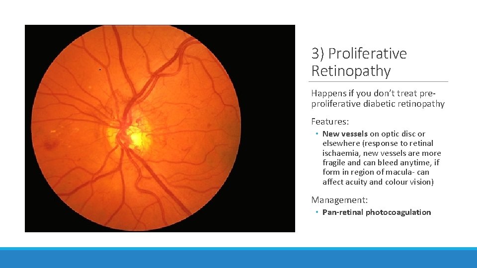 3) Proliferative Retinopathy Happens if you don’t treat preproliferative diabetic retinopathy Features: • New