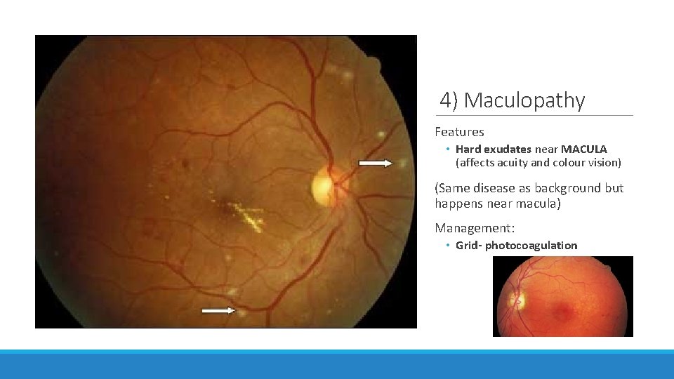 4) Maculopathy Features • Hard exudates near MACULA (affects acuity and colour vision) (Same