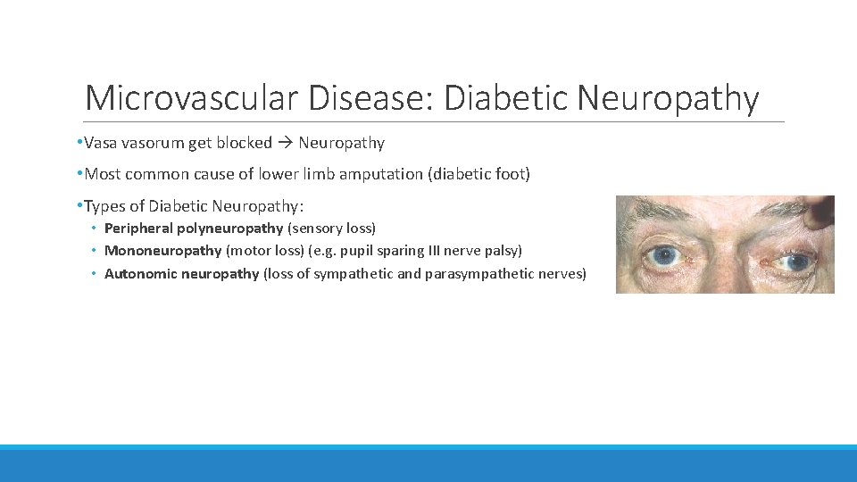 Microvascular Disease: Diabetic Neuropathy • Vasa vasorum get blocked Neuropathy • Most common cause