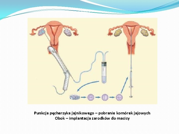 Punkcja pęcherzyka jajnikowego – pobranie komórek jajowych Obok – implantacja zarodków do macicy 