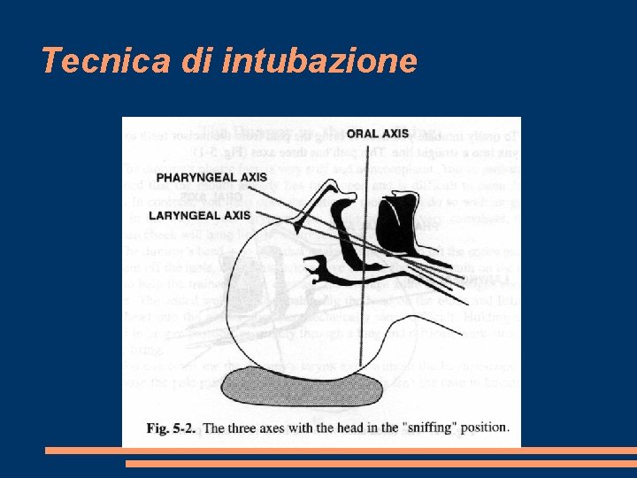 Tecnica di intubazione 