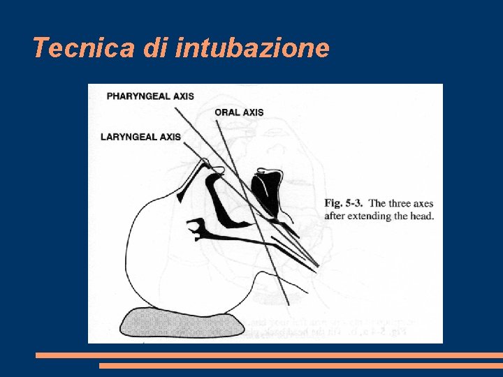 Tecnica di intubazione 