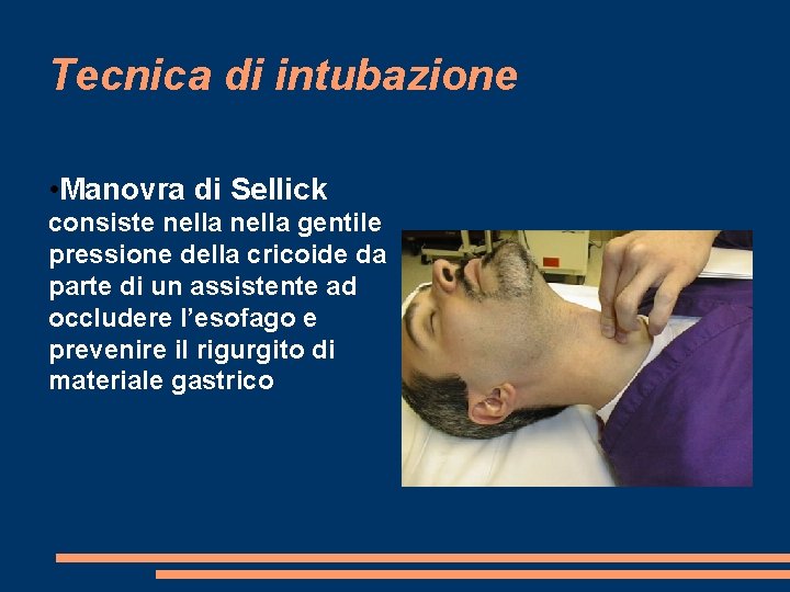 Tecnica di intubazione • Manovra di Sellick consiste nella gentile pressione della cricoide da