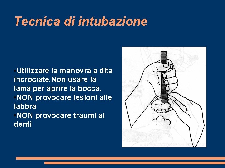 Tecnica di intubazione • Utilizzare la manovra a dita incrociate. Non usare la lama