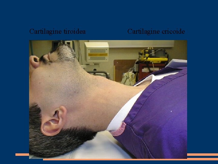 Cartilagine tiroidea Cartilagine cricoide 