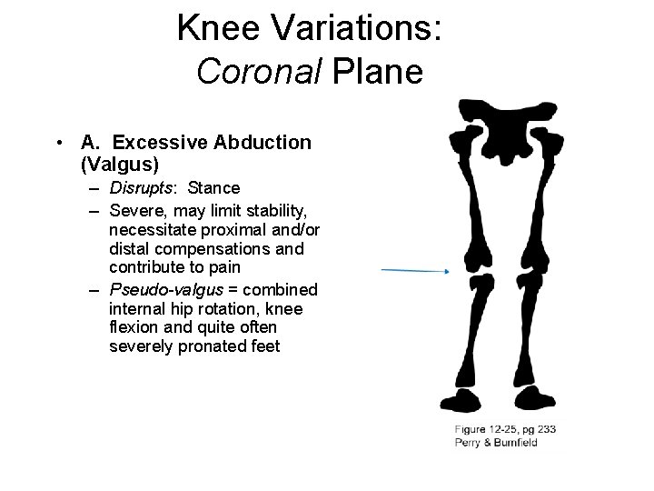 Knee Variations: Coronal Plane • A. Excessive Abduction (Valgus) – Disrupts: Stance – Severe,