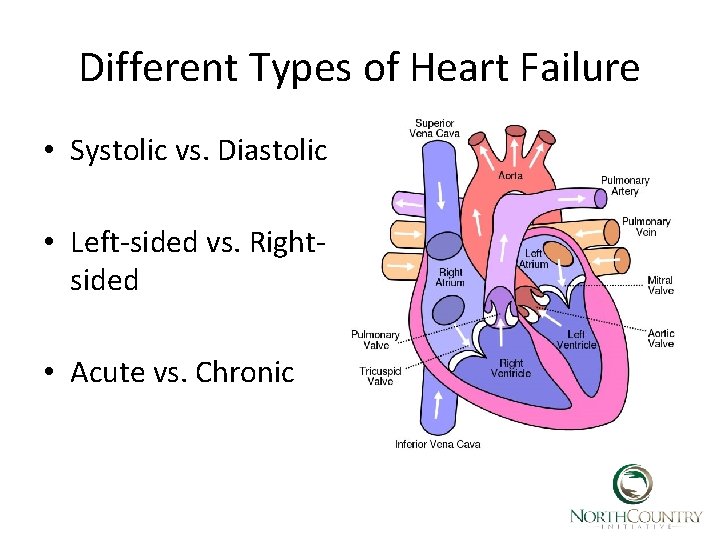 Different Types of Heart Failure • Systolic vs. Diastolic • Left-sided vs. Rightsided •