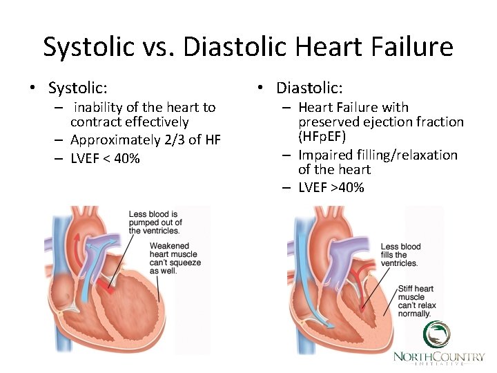 Systolic vs. Diastolic Heart Failure • Systolic: – inability of the heart to contract