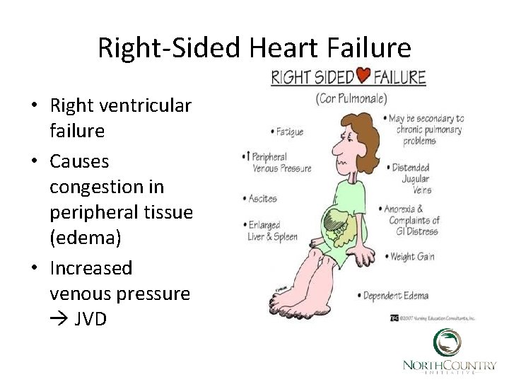 Right-Sided Heart Failure • Right ventricular failure • Causes congestion in peripheral tissue (edema)