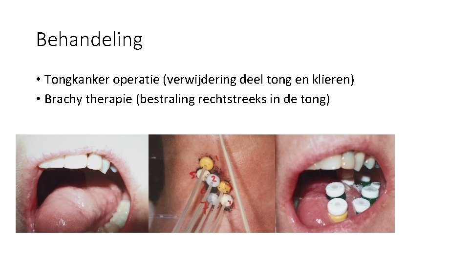 Behandeling • Tongkanker operatie (verwijdering deel tong en klieren) • Brachy therapie (bestraling rechtstreeks