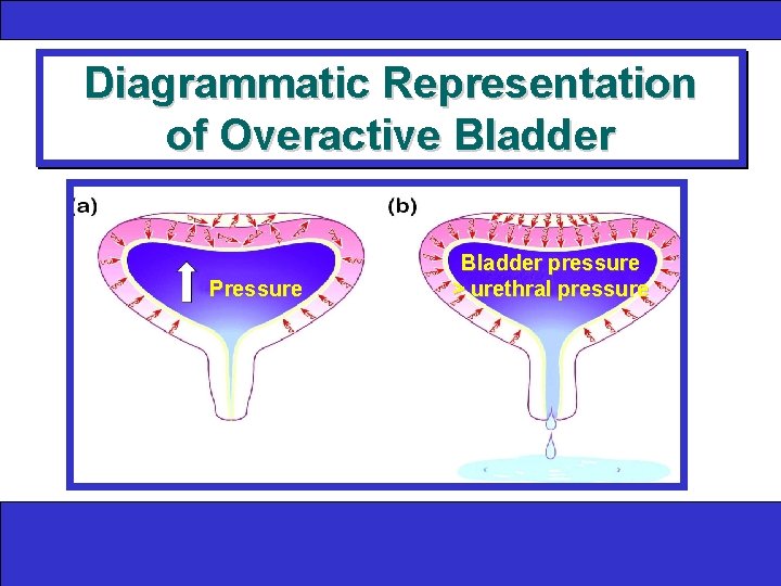 Diagrammatic Representation of Overactive Bladder Pressure Bladder pressure > urethral pressure 