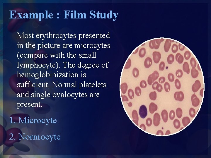 Example : Film Study Most erythrocytes presented in the picture are microcytes (compare with