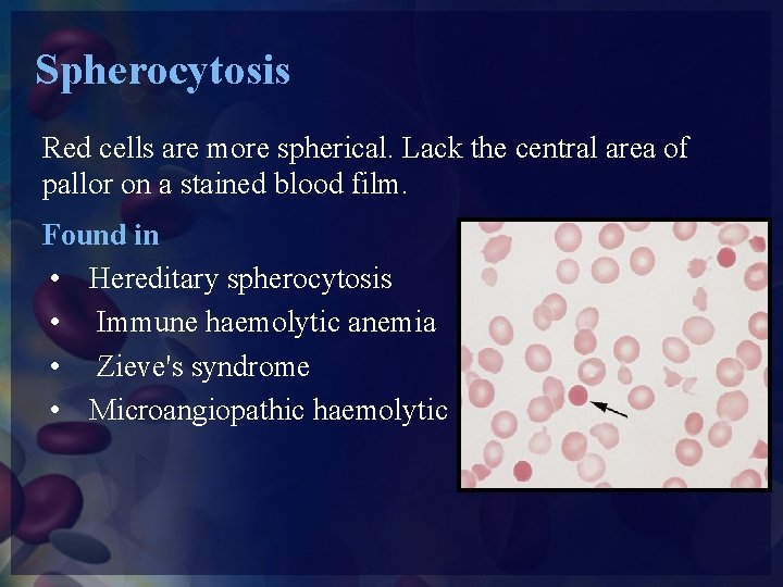 Spherocytosis Red cells are more spherical. Lack the central area of pallor on a