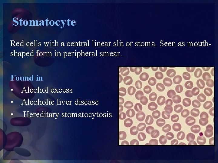 Stomatocyte Red cells with a central linear slit or stoma. Seen as mouthshaped form