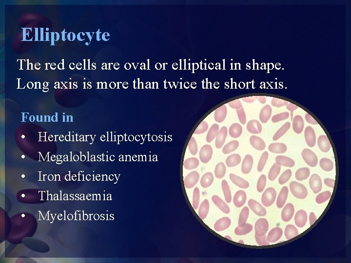 Elliptocyte The red cells are oval or elliptical in shape. Long axis is more