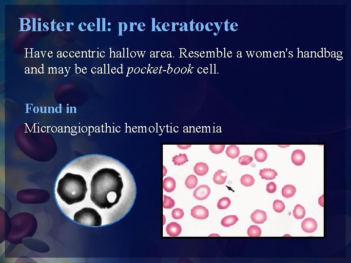 Blister cell: pre keratocyte Have accentric hallow area. Resemble a women's handbag and may