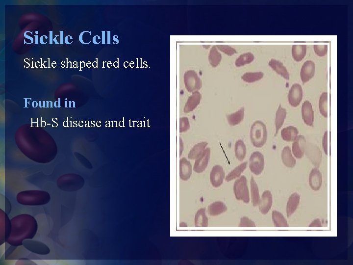 Sickle Cells Sickle shaped red cells. Found in Hb-S disease and trait 