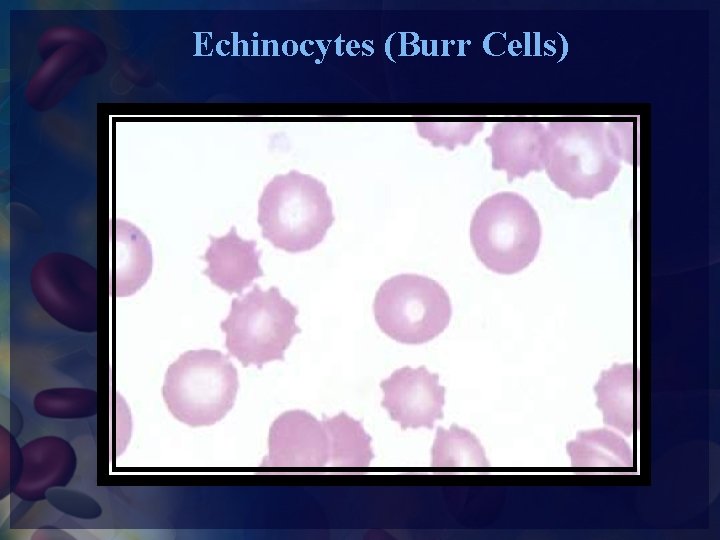 Echinocytes (Burr Cells) 
