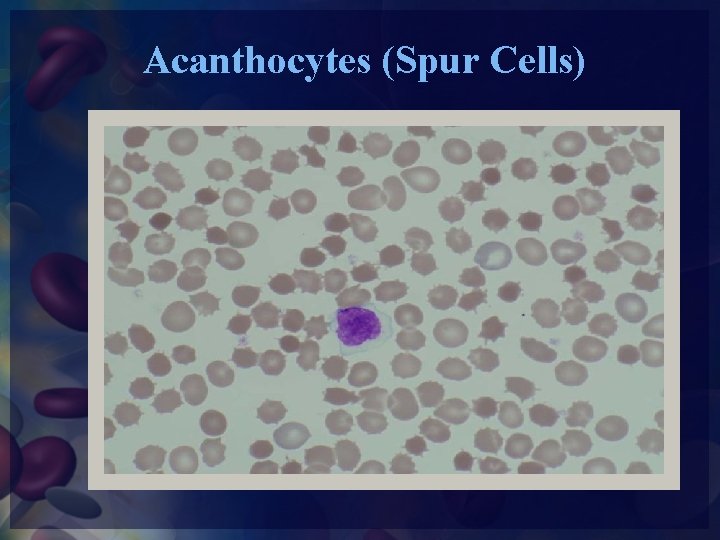 Acanthocytes (Spur Cells) 