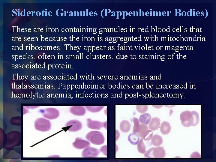 Siderotic Granules (Pappenheimer Bodies) These are iron containing granules in red blood cells that