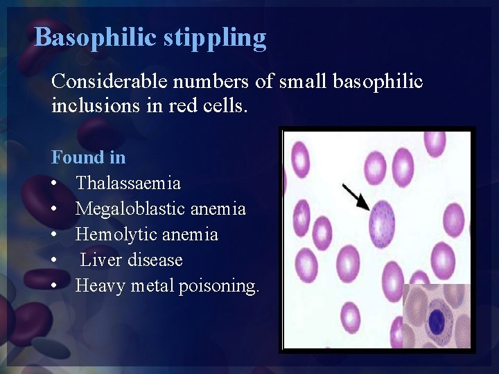 Basophilic stippling Considerable numbers of small basophilic inclusions in red cells. Found in •