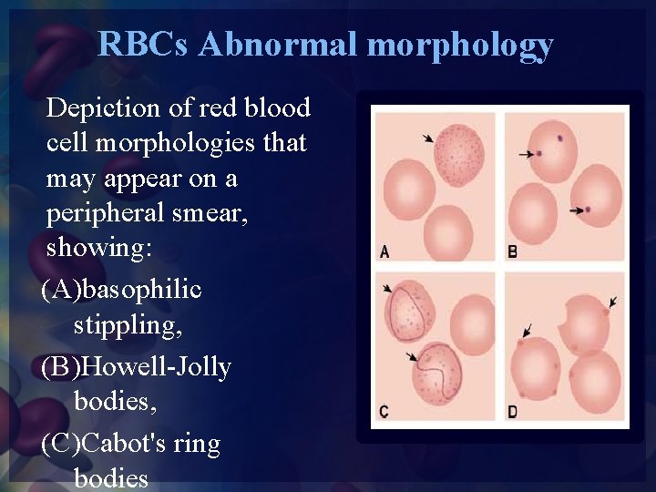 RBCs Abnormal morphology Depiction of red blood cell morphologies that may appear on a