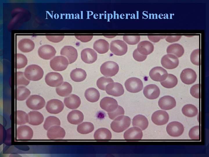 Normal Peripheral Smear 