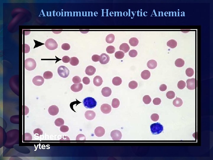 Autoimmune Hemolytic Anemia Spheroc ytes 