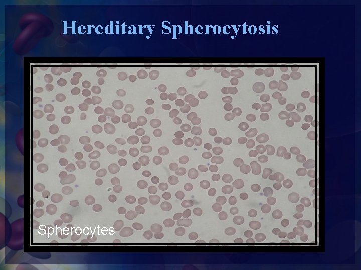 Hereditary Spherocytosis Spherocytes 