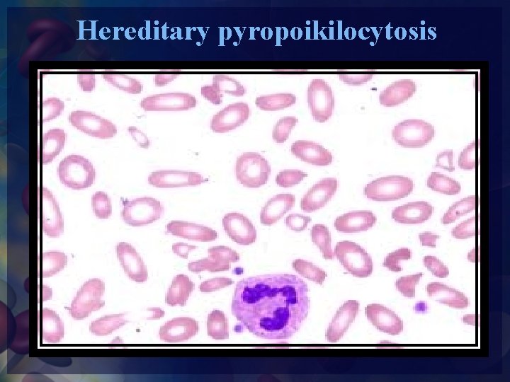 Hereditary pyropoikilocytosis 