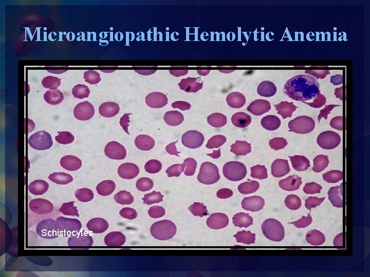 Microangiopathic Hemolytic Anemia Schistocytes 