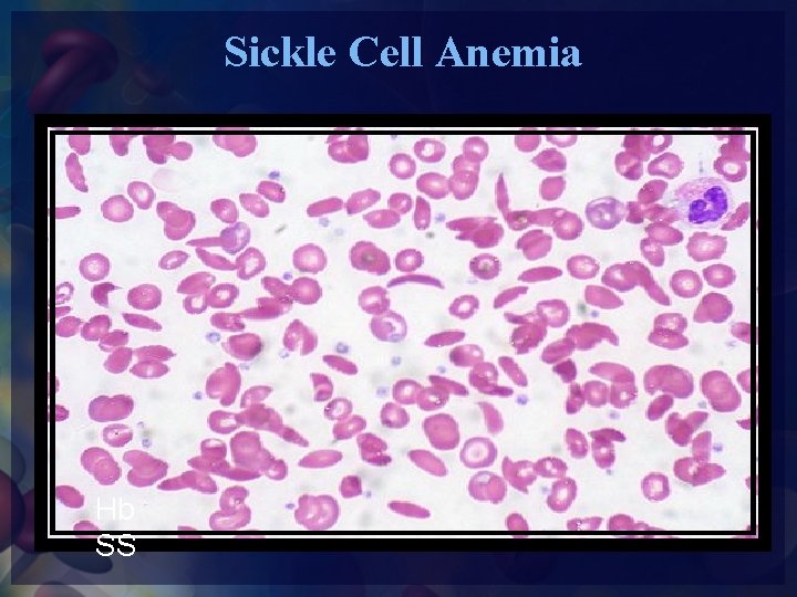 Sickle Cell Anemia Hb SS 
