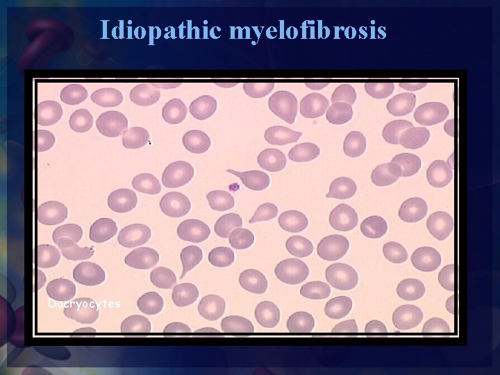 Idiopathic myelofibrosis Dacryocytes 