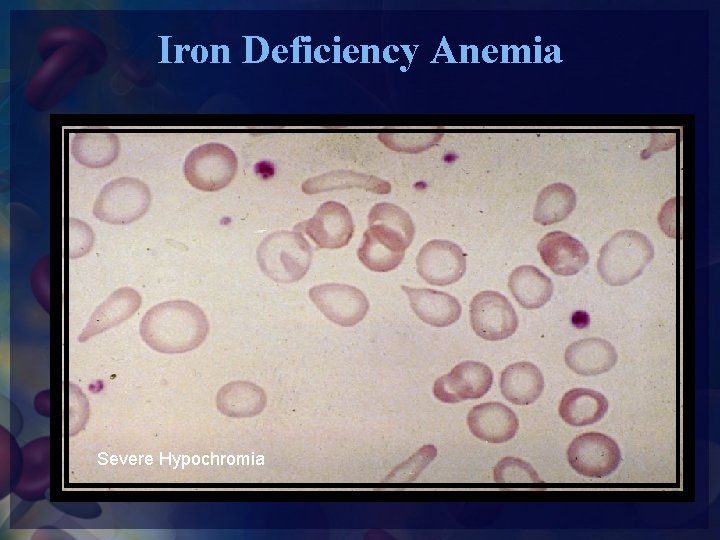 Iron Deficiency Anemia Severe Hypochromia 