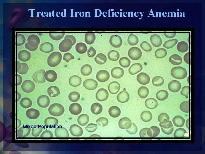 Treated Iron Deficiency Anemia Mixed Population: 